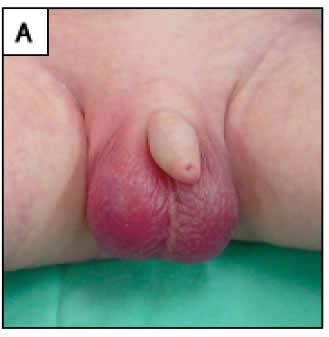 hernia inguinal