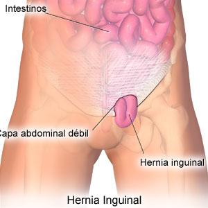 hernia inguinal