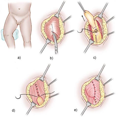 hernia inguinal