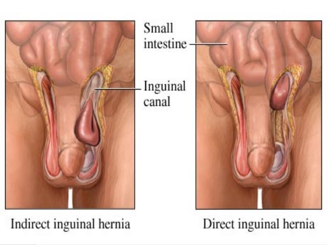 hernia-inguinal-r2-18-638