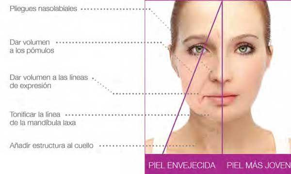profound de syneron candela
