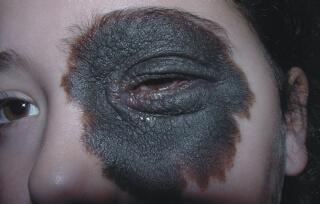 por que tenemos lunares