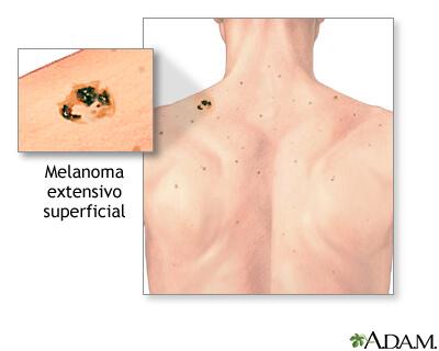 por que tenemos lunares