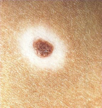 por que tenemos lunares