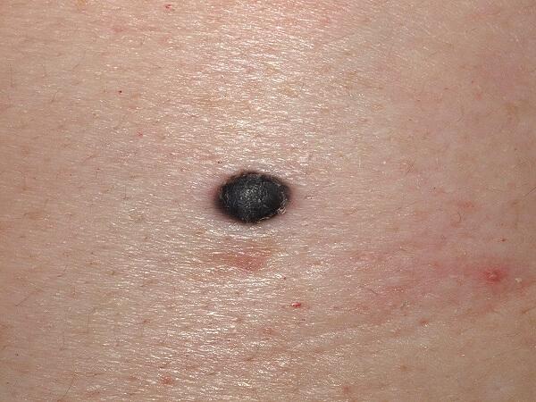 por que tenemos lunares