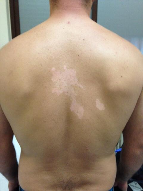 por que tenemos lunares