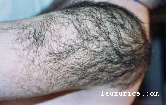 por que tenemos lunares