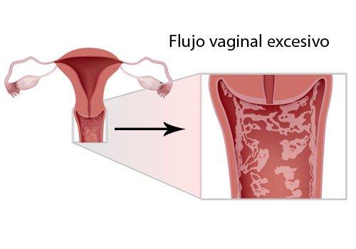 infeccion vaginal
