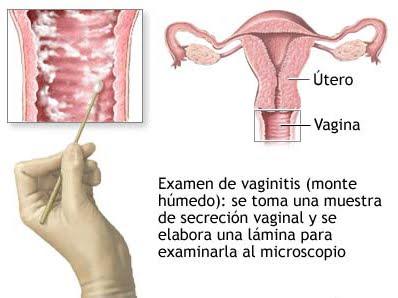 infeccion vaginal