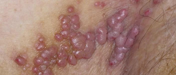 virus de papiloma huano