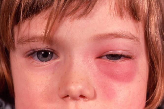 como prevenir la congestion nasal