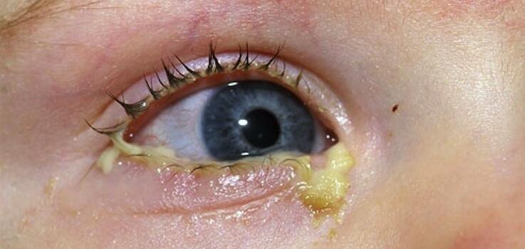 tipos de conjuntivitis