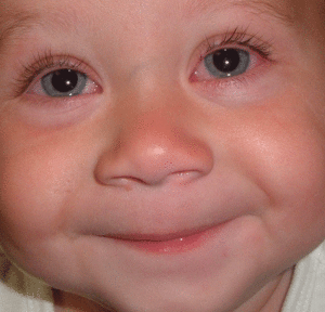 tipos de conjuntivitis