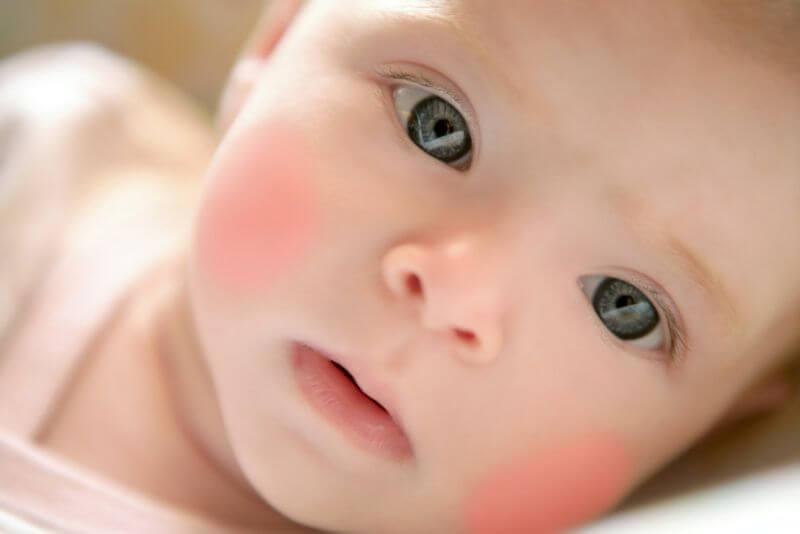 dermatitis atopica