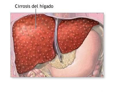 tipos de hepatitis