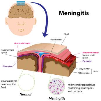 como prevenir la meningitis
