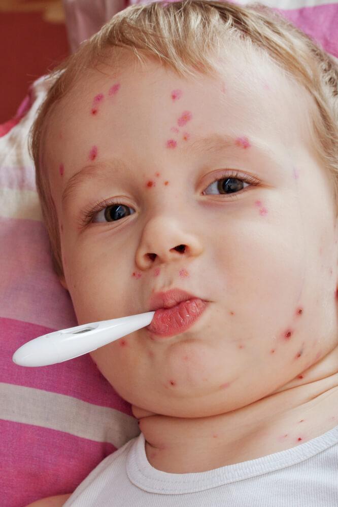 como prevenir la meningitis