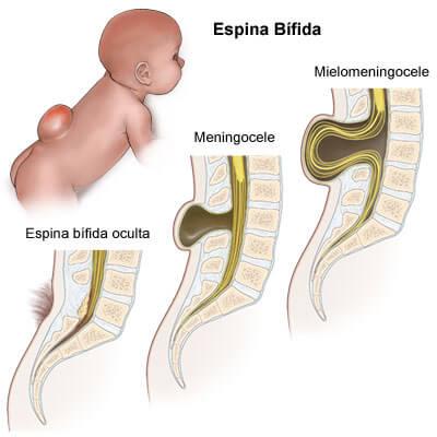 deficiencia de vitamina B