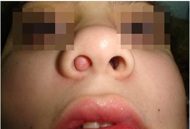 que son polipos nasales