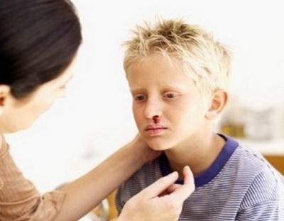 que son polipos nasales