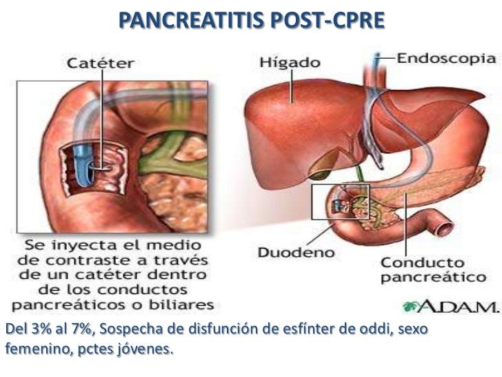 inflamacion del pancreas