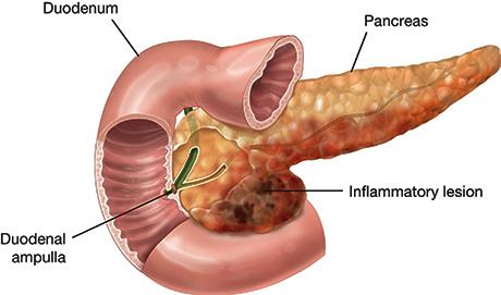 inflamacion del pancreas
