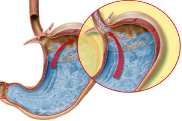 dolor abdominal en niños