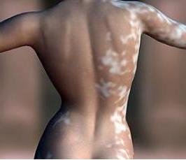 manchas blancas piel