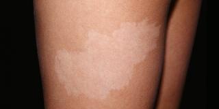 nevus depigmentosa manchas piel