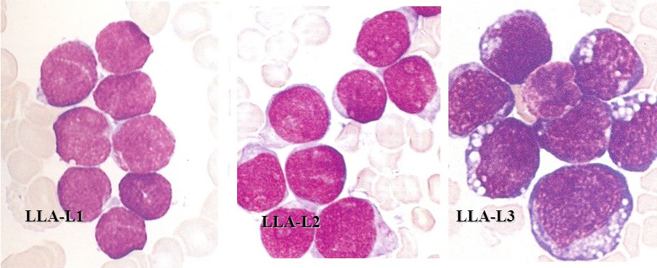 Leucemia linfoblástica aguda-clasificación