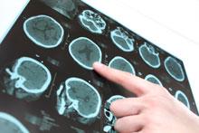 Enfermedad de Alzheimer y estrés oxidativo