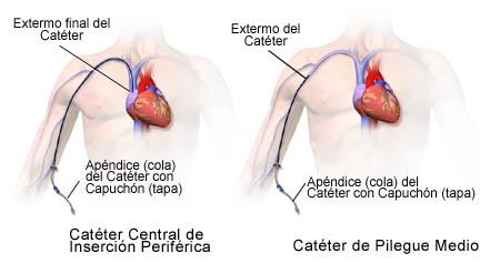 Colocación del catéter para nutrición parenteral