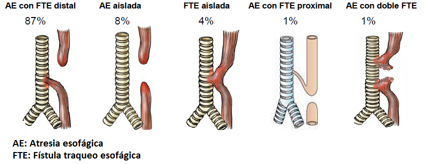 Clasificación de la atresia esofágica