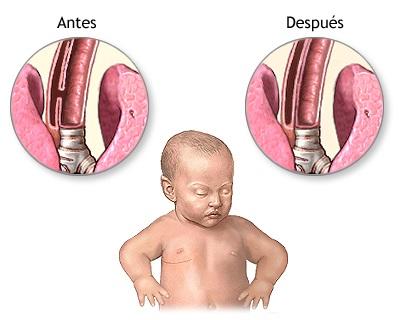 Corrección quirúrgica de atresia de esófago