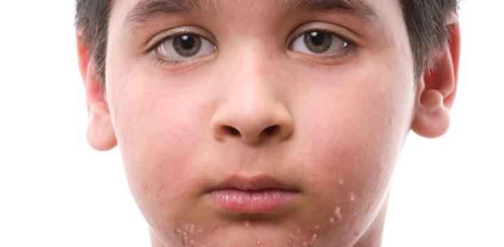 infecciones de la piel por virus como prevenirlo