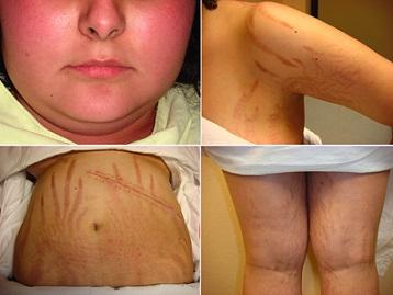 síndrome de cushing signos y sintomas