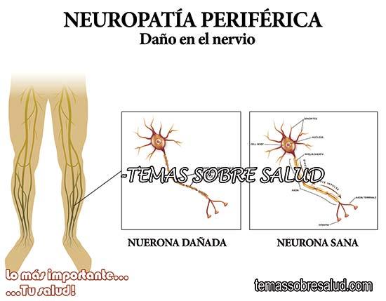 neuropatía
