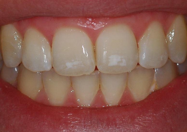 dientes con manchas blancas