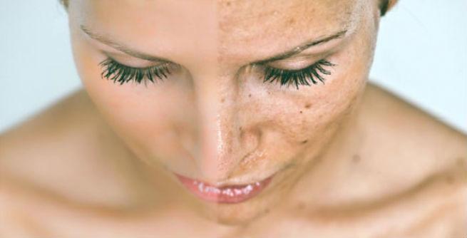 remedios caseros para eliminar manchas oscuras en la cara