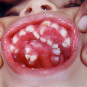 Dientes supernumerarios