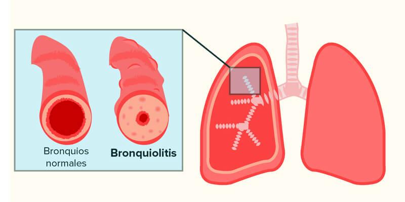 Patogenia de bronquiolitis
