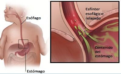 Reflujo gastroesofágico