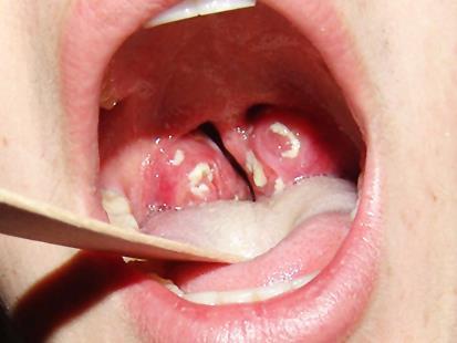 amigdalas inflamadas 005