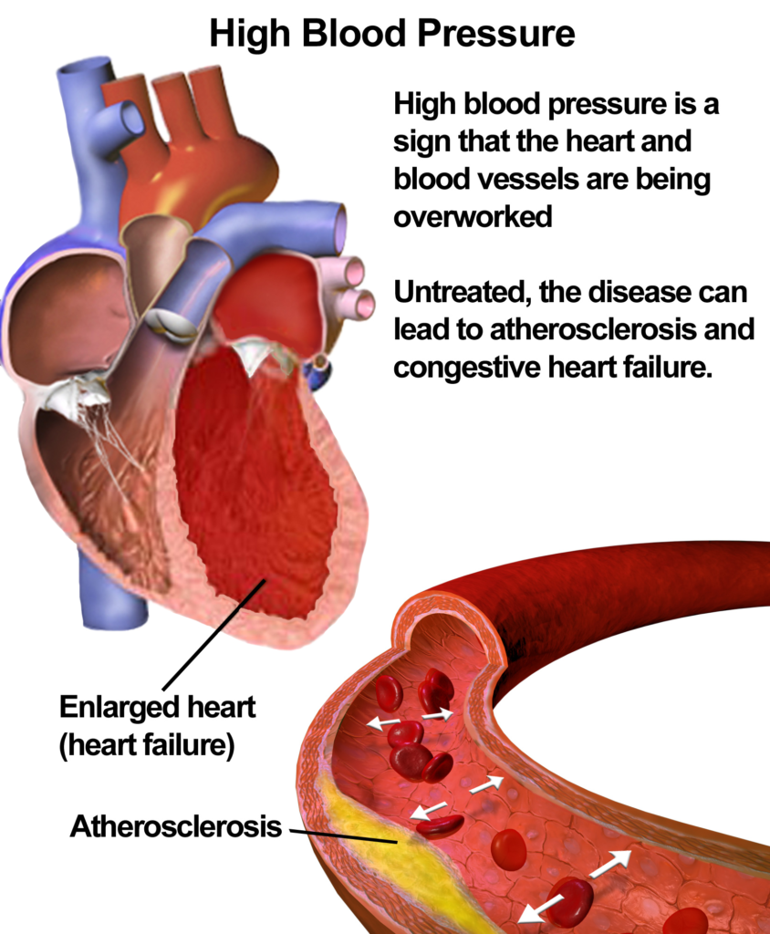 Presión arterial