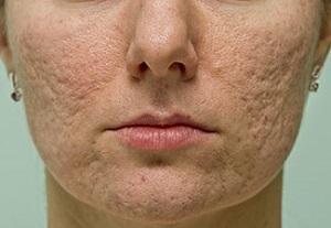 eliminar marcas de acné