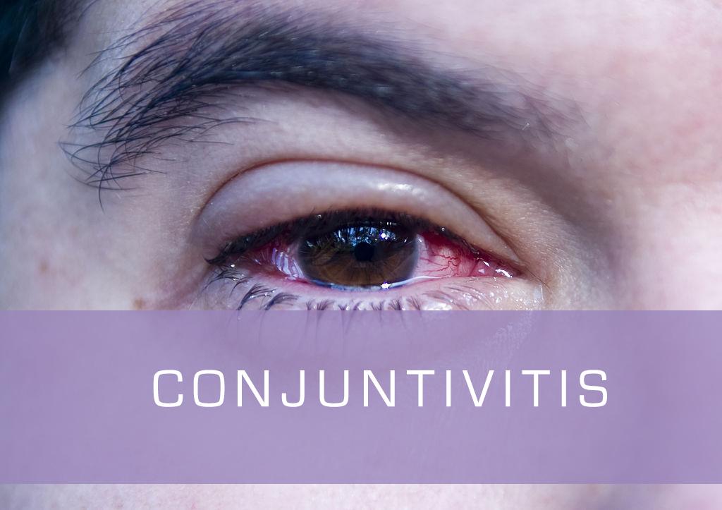 conjuntivitis, ojo rojo