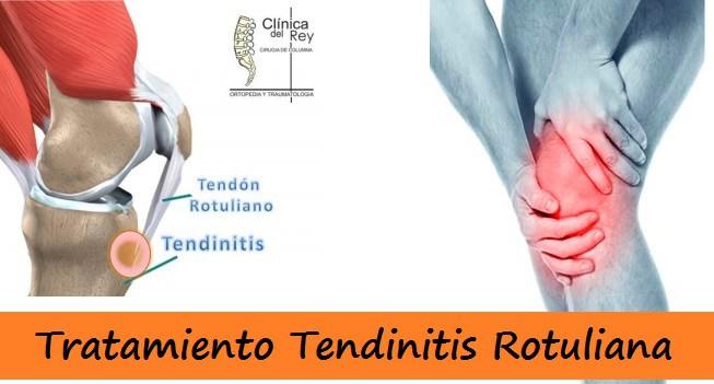 Tratamiento de la Tendinitis Rotuliana