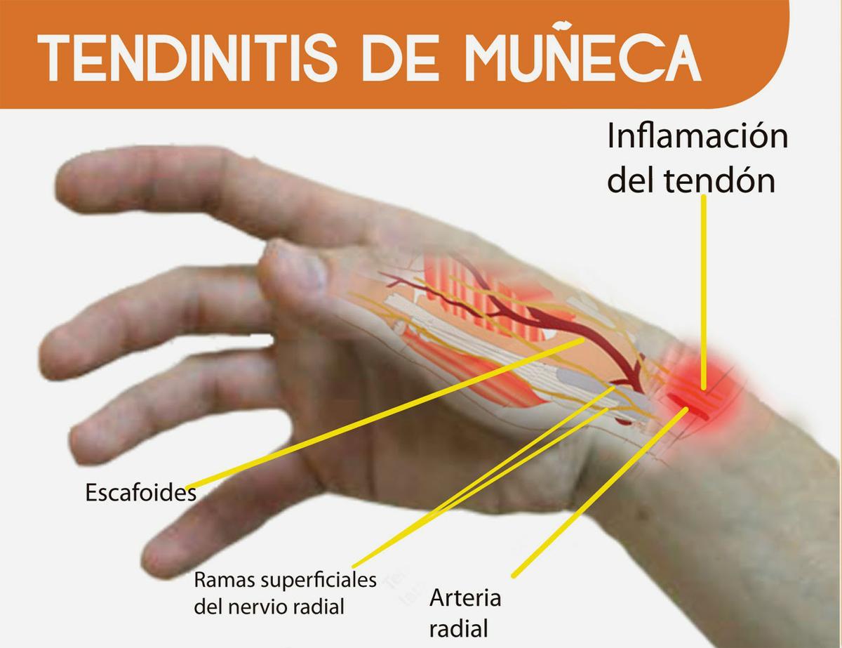 Tendinitis de muñeca