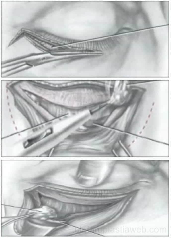 la blefaroplastia transconjuntival se aplica para eliminar las bolsas de los ojos