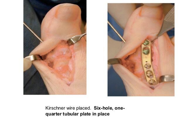 Cirugía de hallux valgus